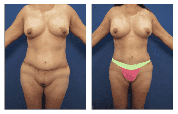 Best tummy tuck revision