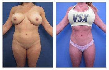 What is a Mini Tummy Tuck, SurgiSculpt