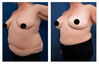 Bilateral Breast Mastectomy and Reconstruction Provides Improved Cosmetic Results