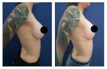 How to Fix Poor Areola Scarring After Breast Lift