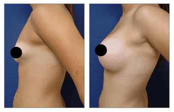 Correcting Congenital Breast Deformity