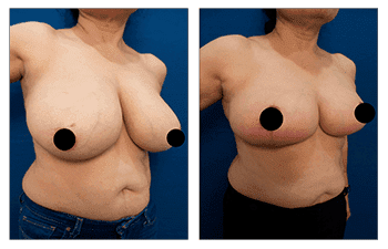 Redness Over Lower Breast Following Breast Lift