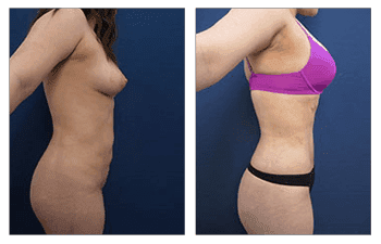 High Definition Mini Tummy Tuck before and after.