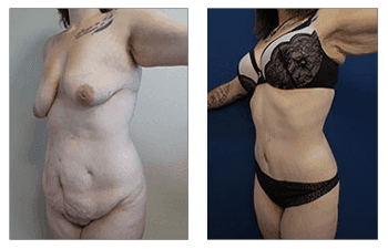 Do I Have Lipedema?