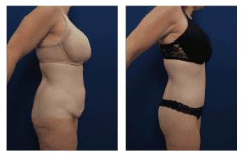 Buttock Augmentation Surgery Photos