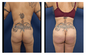 Round vs Oval Buttock Implants