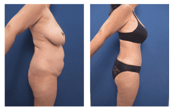 Brazilian Buttock Lift Recovery