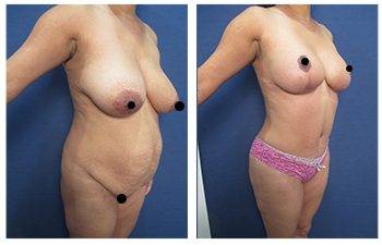 Mommy Makeover To Correct Diastasis Recti