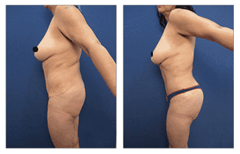 Best female abdominal contouring