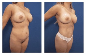 Liposuction in Newport Beach