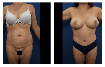 VASER Tummy Tuck