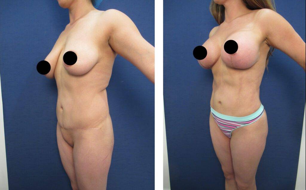 Who Qualifies for Mini Tummy Tuck