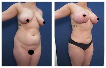 Mommy Makeover - Upper Belly Fullness