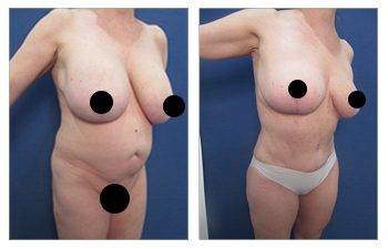 High Definition Tummy Tuck