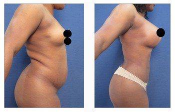 Brazilian Buttock Lift Revision Surgery