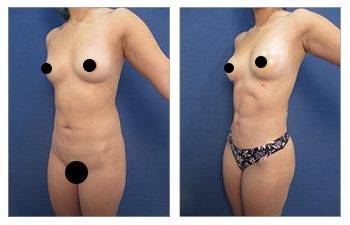 Combining tummy tuck with Lipo 360
