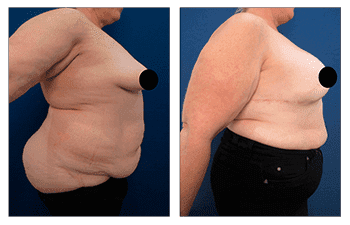 Bilateral Breast Mastectomy and Reconstruction Provides Improved Cosmetic Results