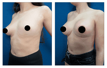 Correcting Breast Asymmetry