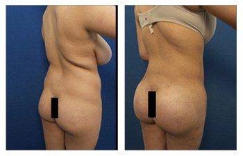 how common are buttock implants