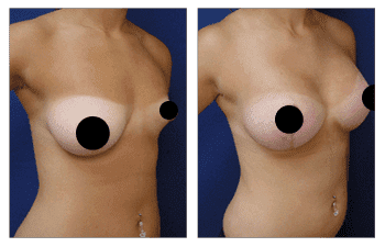 Correcting Congenital Breast Deformity