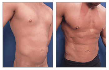 Best Male Abdominal Etching Results