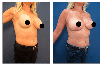 Boob Job to Fix Operated Looking Breasts