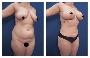 Breast Lift with Implants Near Me