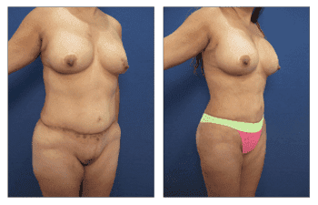 Best tummy tuck revision