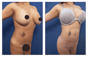 Abdominal Etching With Mini Tummy Tuck