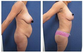 Mommy Makeover To Correct Diastasis Recti