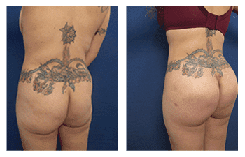 Round vs Oval Buttock Implants