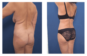 Brazilian Buttock Lift Recovery