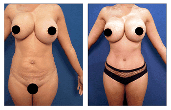 Avoid dog ears following tummy tuck