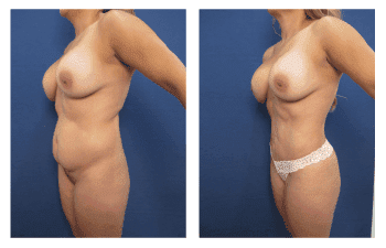 Liposuction in Newport Beach