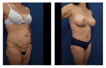 VASER Tummy Tuck