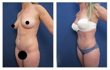 Mini Tummy Tuck Before and After Photo Gallery, Los Angeles, CA