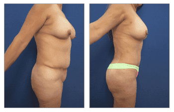 Tummy Tuck or Liposuction: Which Is the Better Solution for Your Muffin  Top?: Best Impression Med Spa: Medical Spa