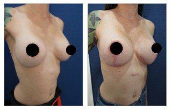 How to Fix Poor Areola Scarring After Breast Lift