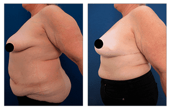 Bilateral Breast Mastectomy and Reconstruction Provides Improved Cosmetic Results