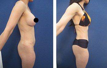 360 Liposuction, SurgiSculpt