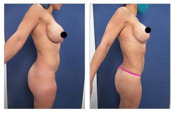 Liposuction of the Waist