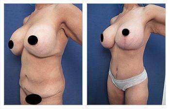 Mommy Makeover With Tummy Tuck And Breast Lift