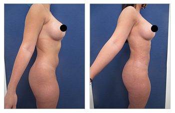 Renuvion scarless skin tightening