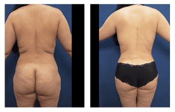 Liposuction Before and After Photos