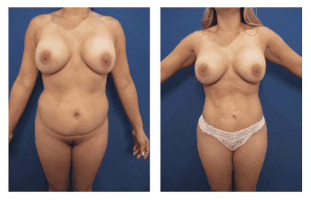 Liposuction in Newport Beach