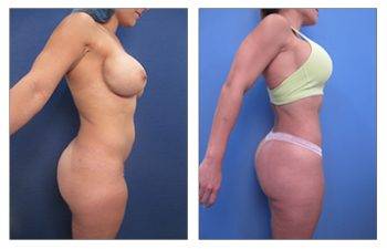 What is a Mini Tummy Tuck