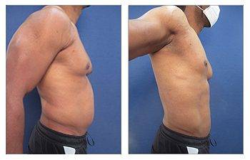 High Definition Abdominal Contouring for the Large Weight Loss Male Patient