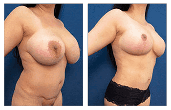 Best Breast lift revision