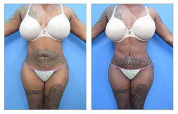 HD Liposuction 360, SurgiSculpt