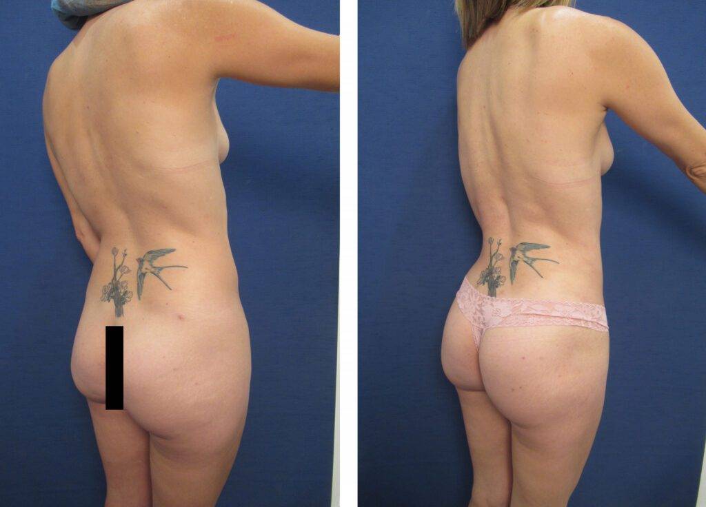 Brazilian Buttock Lift Revision Before And After